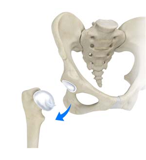 Hip Dislocation 