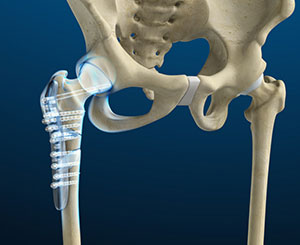 Hip Fracture ORIF 