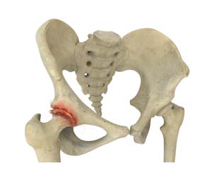 Transient Osteoporosis of the Hip 