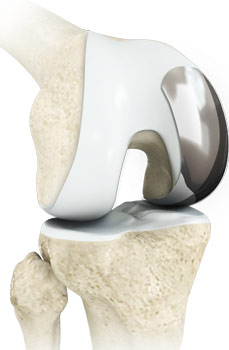 Unicondylar knee Replacement