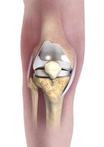 Patient Specific Knee Replacement